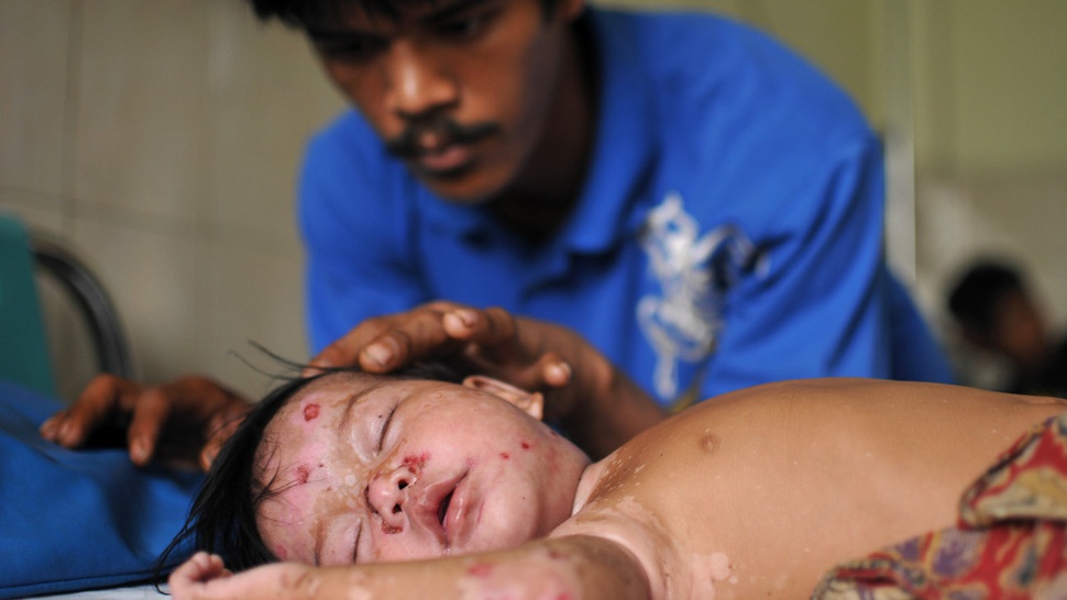 Bayi Orang Rimba Menderita 'Stevens-Johnson Syndrome' 