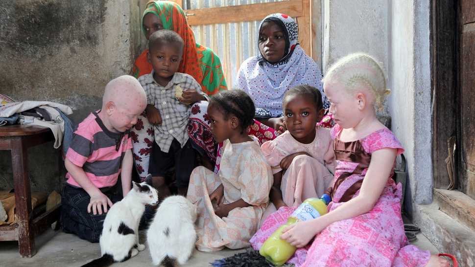 Perburuan Albino di Afrika