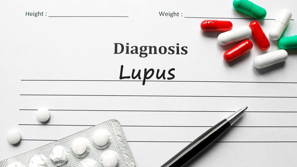Ketahui 3 Penyebab Penyakit Lupus, Gejala dan Pencegahannya
