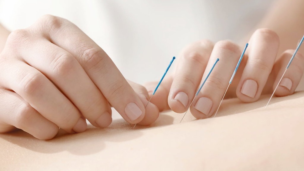 Mengenal Terapi Akupunktur Medik untuk Program Hamil