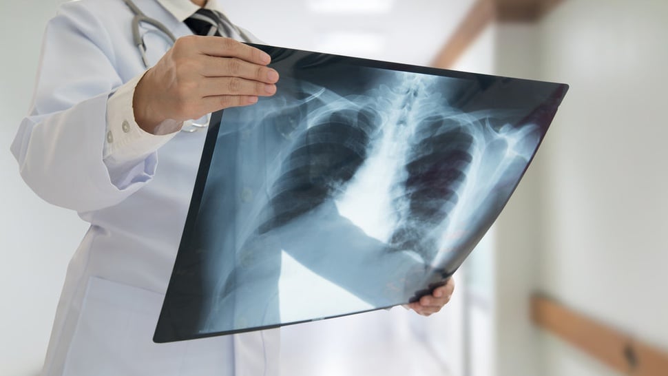 Langkah Pencegahan Pneumonia pada Lansia dan Ketahui Bahayanya