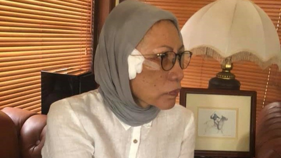 Ratna Sarumpaet Lebam Setelah Operasi Plastik, Kenali Penyebabnya