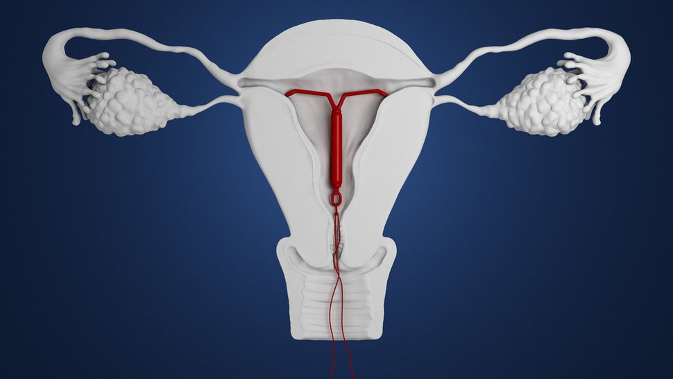 Mengenal IUD, Jenis Kontrasepsi Spiral untuk Menunda Kehamilan