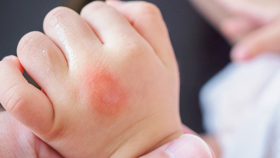 Mengenal Allergic March pada Bayi: Penyebab dan Cara Mengatasinya