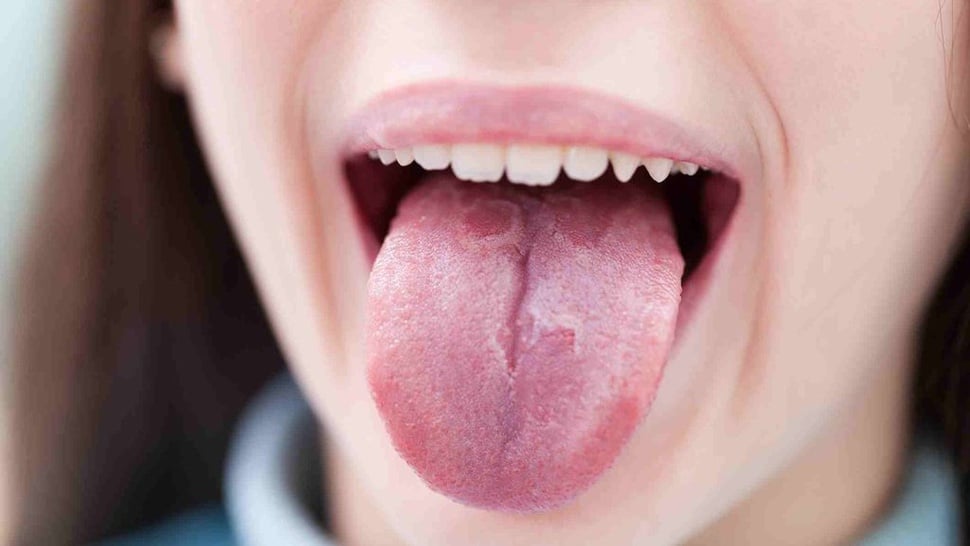 'COVID Tongue' atau Bercak Lidah Jadi Gejala Baru Corona, Kata Ahli