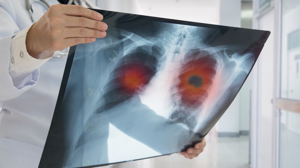 Kanker Paru-paru Disebabkan Oleh Apa, Gejala dan Pengobatannya