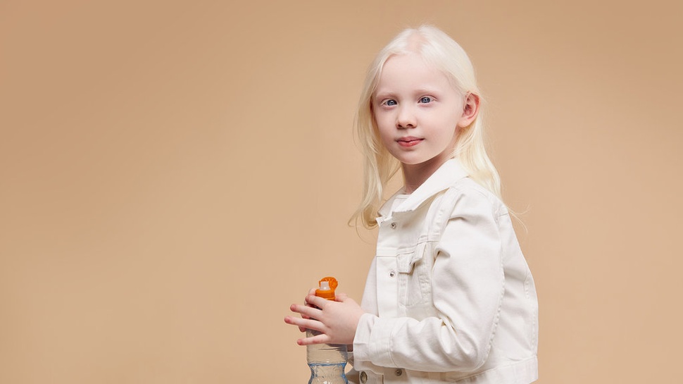 Mengenal Albinisme: 5 Tipe Albino dan Penyebabnya