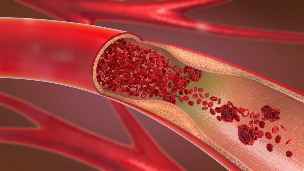 Proses Pembekuan Darah dan Fungsi Trombin dalam Penyembuhan Luka