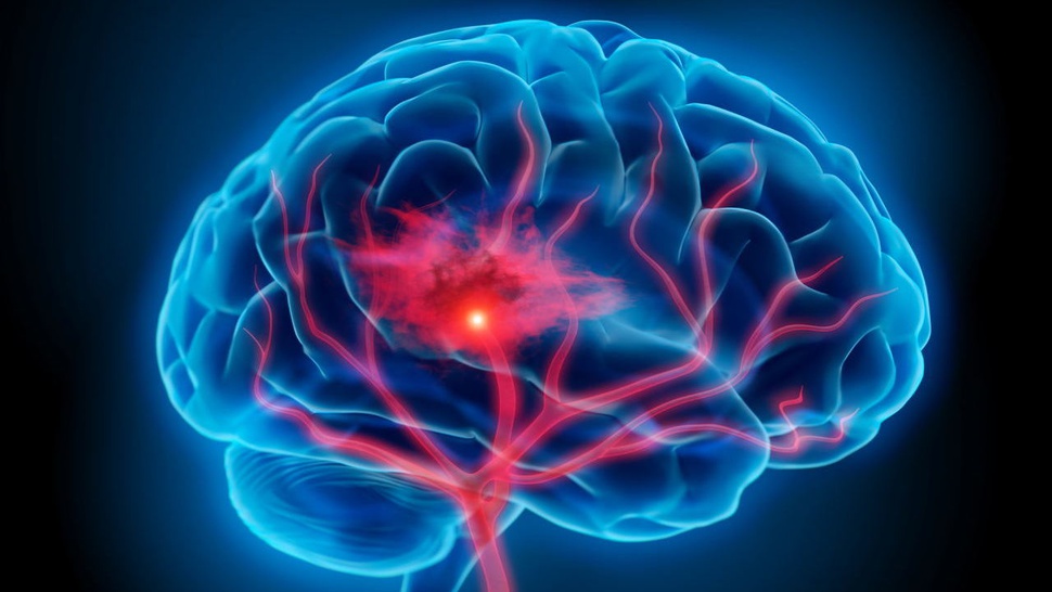 Risiko Kena Kanker Otak Umur Berapa & Cara Mencegahnya