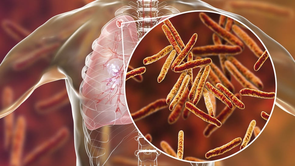 Hari Tuberkulosis Sedunia 2023: Negara dengan Kasus TB Tertinggi