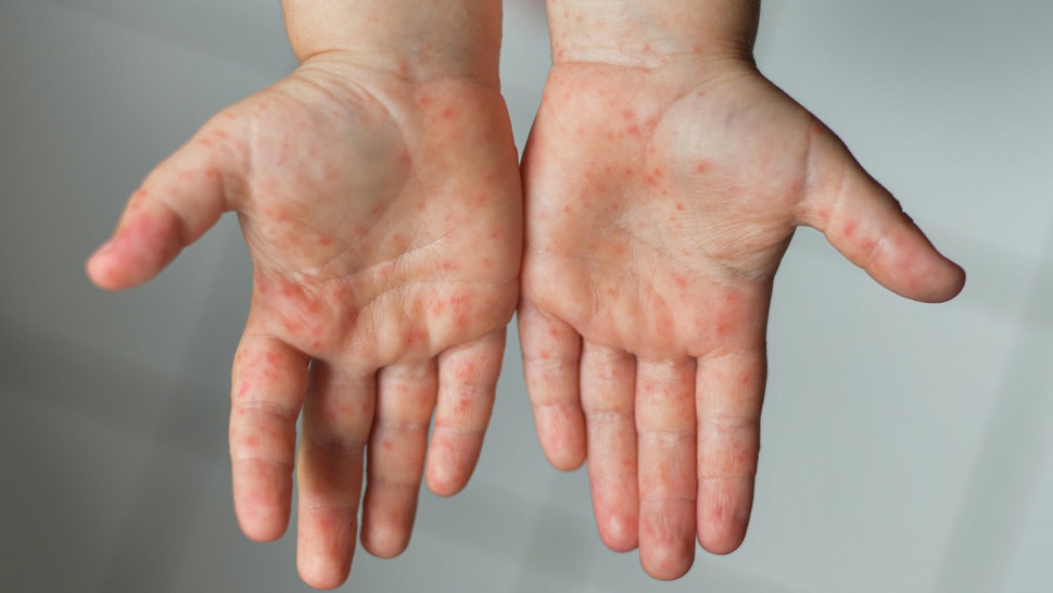 Campak dan Difteri yang Berujung Penyakit Komplikasi pada Anak