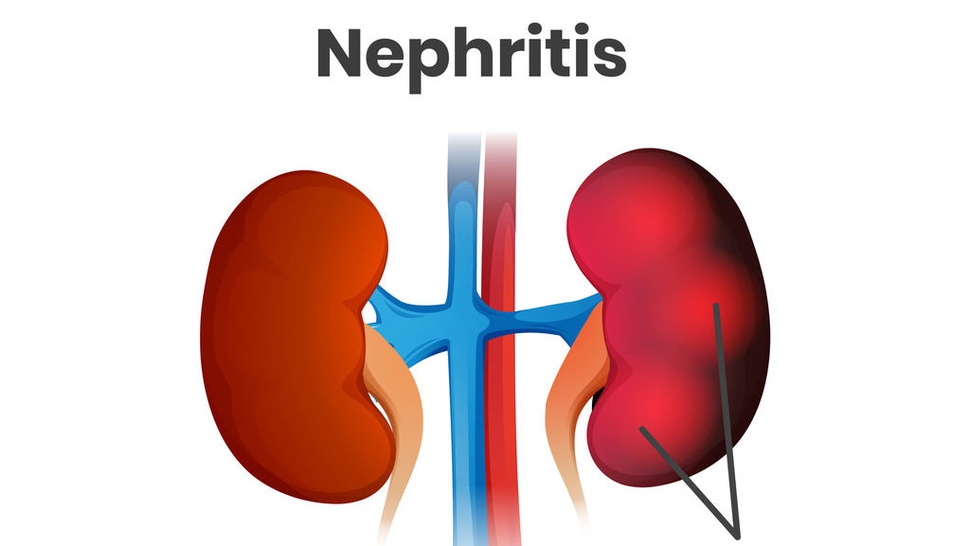 Mengenal Penyakit Nefritis, Gejala, Penyebab & Cara Mencegahnya