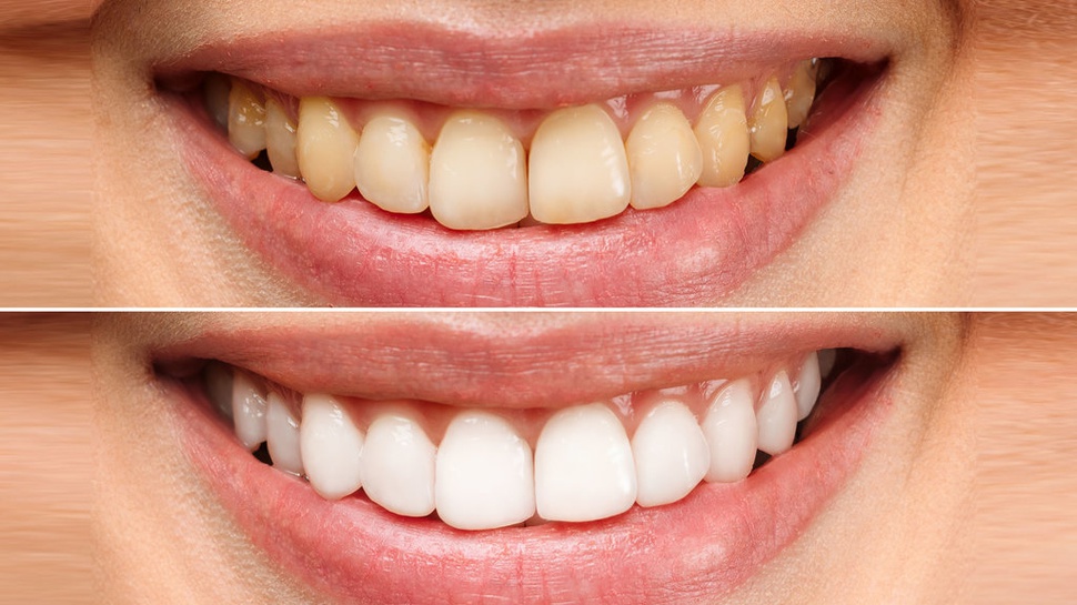 7 Cara Menghilangkan Gigi Kuning Secara Alami & Apa Penyebabnya