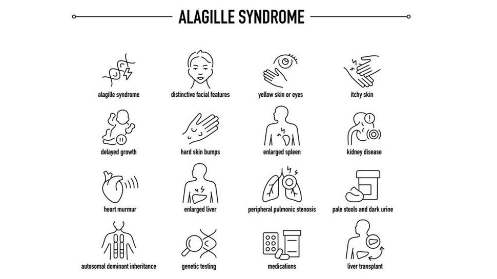 Sindrom Alagille pada Bayi: 11 Gejala, Efek dan Penyebabnya