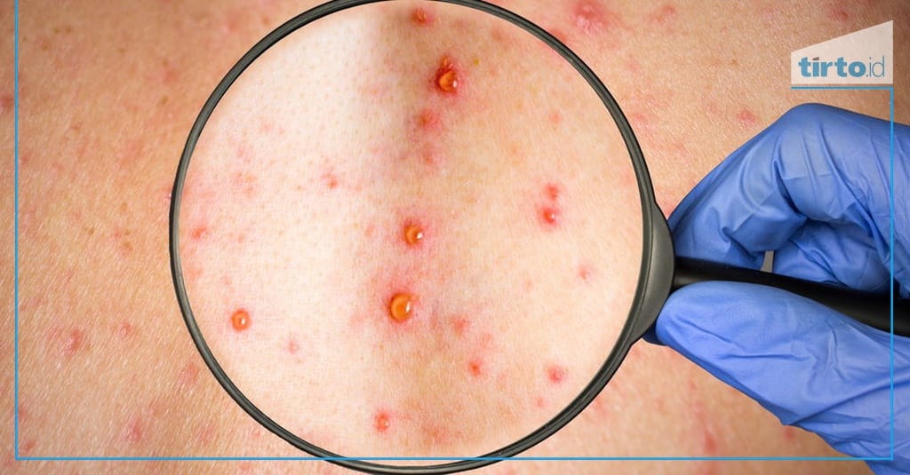 Berita Vaksin Cacar Air Usia Berapa Pemberian Vaksin Cacar Air pada