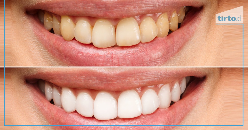 7 Cara Menghilangkan Gigi Kuning Secara Alami & Apa Penyebabnya