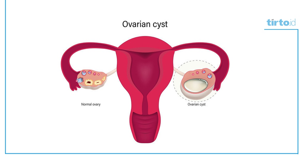 Perbedaan Kista dan Miom, Cara Mendeteksi, Lebih Bahaya Mana?